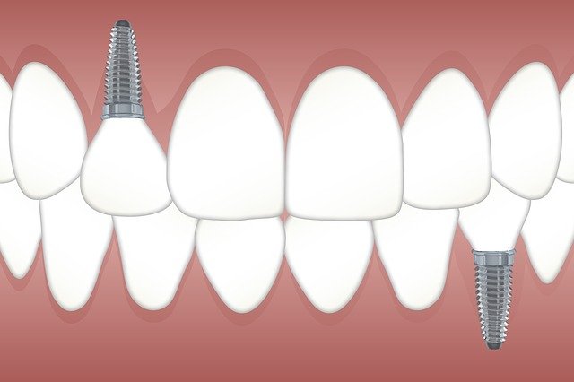 Implanty zębowe kraków