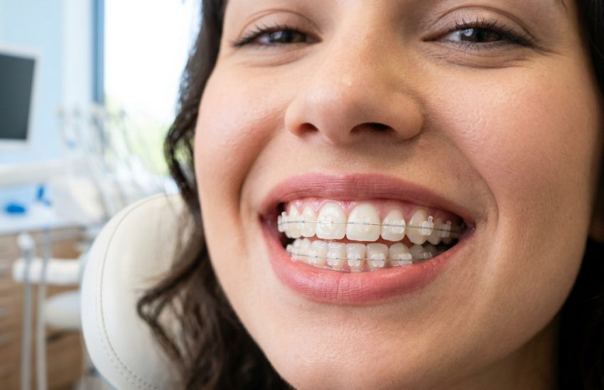 Nowoczesny aparat ortodontyczny, estetyczne zamki